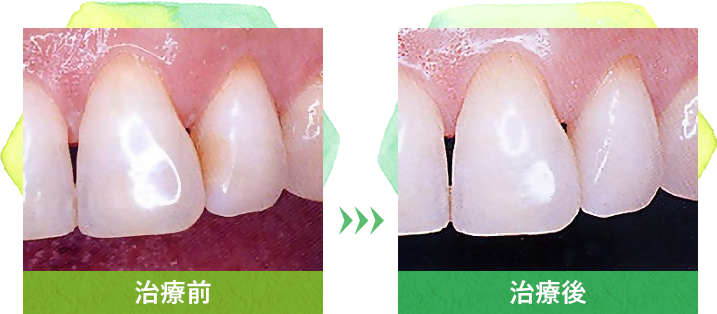 虫歯を削って樹脂（レジン）をつめる治療（1回の処置で治療します）